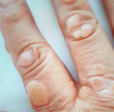 Close-up of human fingers with multiple raised common warts caused by HPV virus.