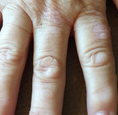 Close-up of common warts on a person's fingers showing rough, raised skin bumps.