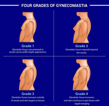 gynecomastia