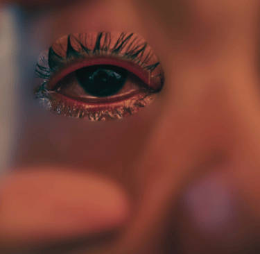 Corneal Abrasion due to contact lenses