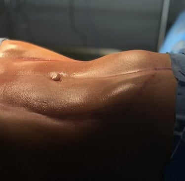 uma mulher com abdômen definido e descoberto com contorno corporal incrível da lipoaspiração