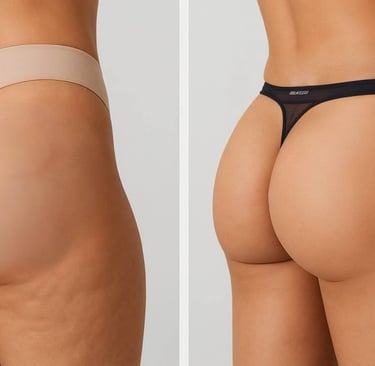 Elevación glúteos/culo. Hilos ácido poliláctico corporal. Eliminación celulitis. Bajar peso.