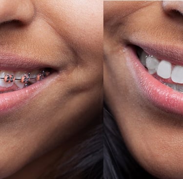 Filipino-Photo-Editor-Brace-Removal-two