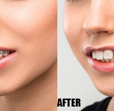Filipino-Photo-Editor-Brace-Removal-three 