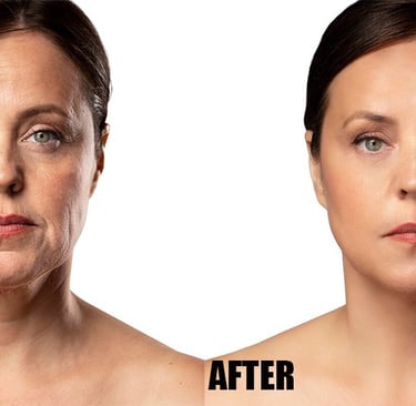 wrinkle-removal