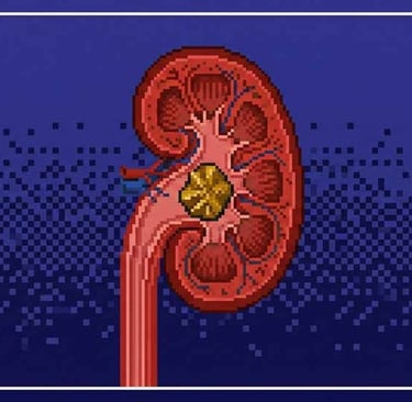 Kidney stone 8-bit version