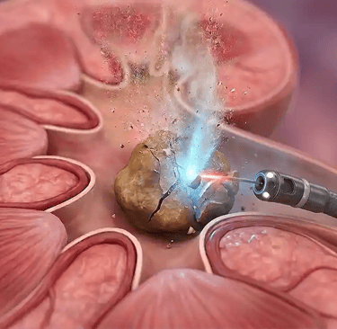 Ureteroscopy and laser breaking a stone in a kidney