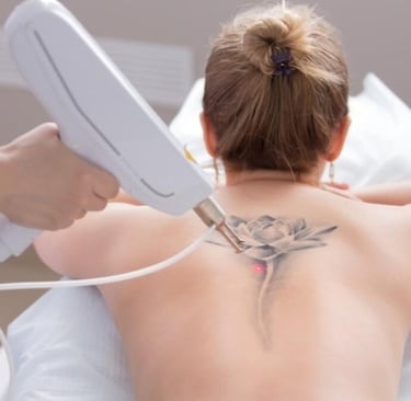 Tatuoinnin laserointi