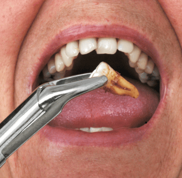 dentist carefully extracting a damaged tooth using dental instruments in a clinical setting."