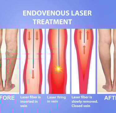 Laser varicose veins in Amman Jordan