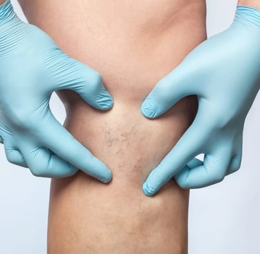 Spider vein sclerotherapy Dr. Omar Hamdallah
