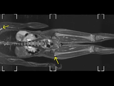 MRI full body scan
