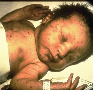 rubella
