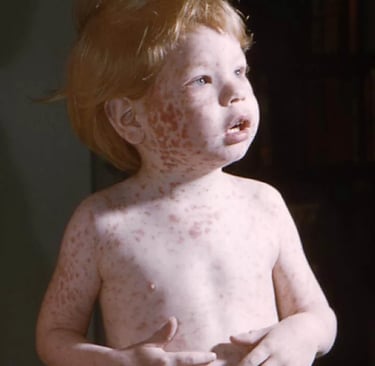 rubella