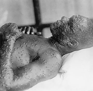Smallpox