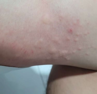 allergic reaction on skin that resembles bites
