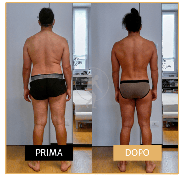 Risoluzione ginocchia valghe uomo di 40 anni Performa Specialists by Dott. Alessandro Rossin