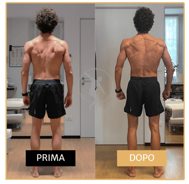 Riduzione curve scoliosi in uomo di 40 anni Performa Specialists By Dott. Alessandro