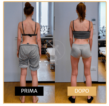 Risoluzione scapole alate ragazza di 17 anni Performa Specialists by Dott. Rossin