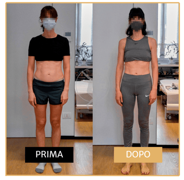 Risoluzione diastasi addominale post-cesareo  donna di 40 anni Performa Specialists by Dott. Rossin