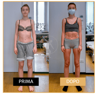 Risoluzione scoliosi adolescenziale ragazza di 17 anni Performa Specialists by Dott. Rossin