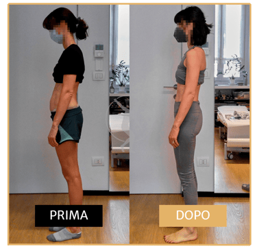 Miglioramento posturale post cesareo donna di 40 anni Performa Specialists by Dott. Rossin