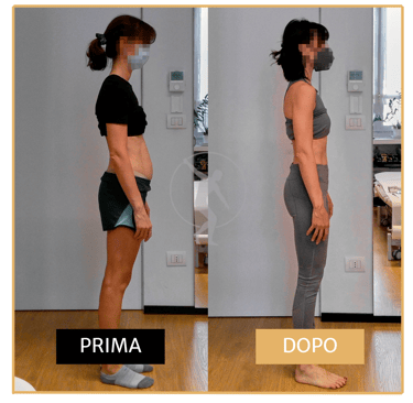 Risoluzione diastasi dei retti post-cesareo donna di 40 anni Performa Specialists by Dott. Rossin