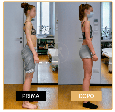 Risoluzione pectum excavatum ragazza di 17 anni Performa Specialists by Dott. Rossin