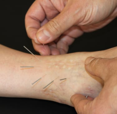 Dr .Robert Inesta Acupuncture