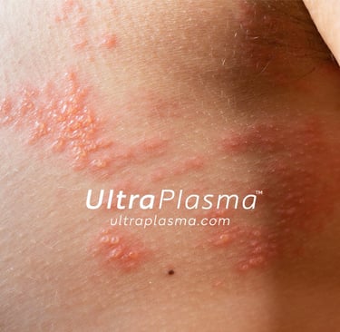 ultraplasma.com_chicken-pox-rash_treatment_su_cicegi_tedavi_ultra_plasma_ultra_plazma