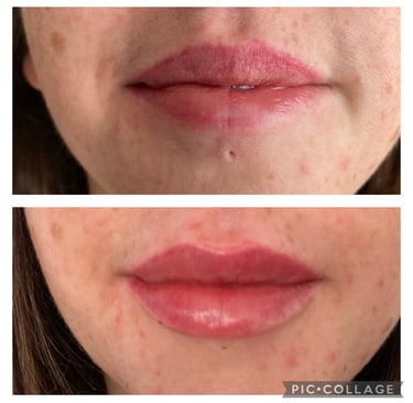 Teoxane Lip Filler