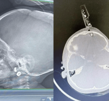 Carregador fica preso no crânio de bebê - (crédito: Cedido ao Correio)