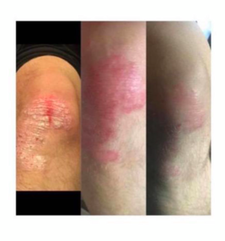 a woman's legs and legs with a red spot on her knee