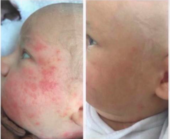 bebé con rosacea en la cara