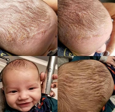 bebé con psoriasis en el cuero cabelludo