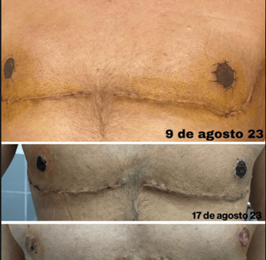 cambio en cicatriz de pecho