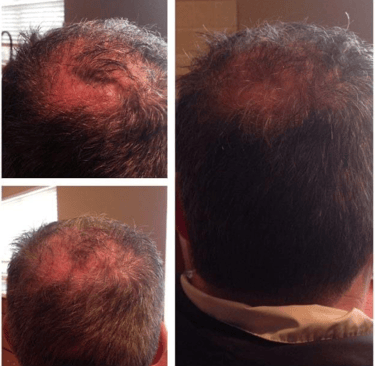 a man with a bald haircut and a bald