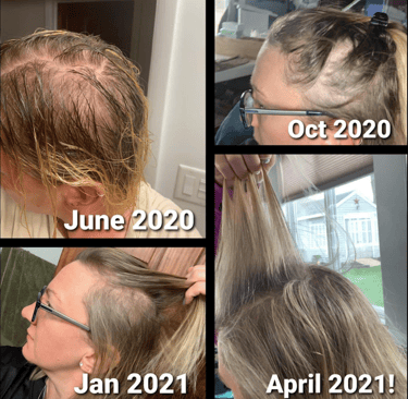 mujer con alopecia androgenetica