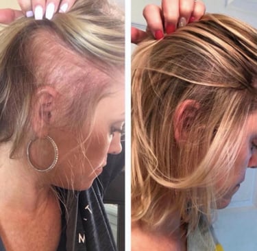 mujer con alopecia andogenetica