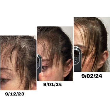 Crecimiento de cabello en las entradas de una mujer