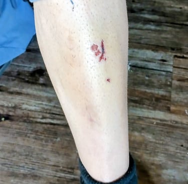 cut on shin from pedal slip