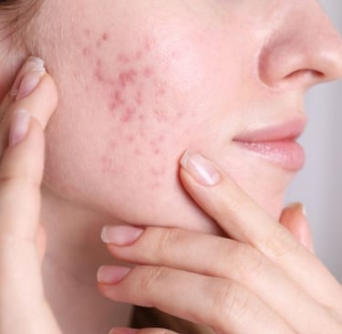woman with acne