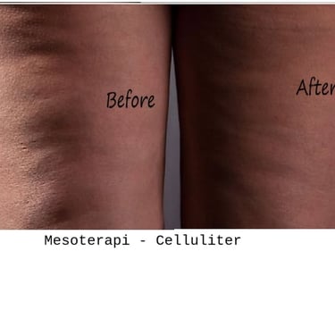 Mesoterapi före- och efterbild mot celluliter på lår med slätare hud efter 4 veckor