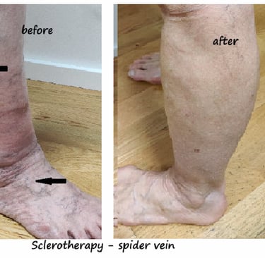 Ben med ådernät före och 6 veckor efter skleroterapi – tydlig minskning av spindelvener. 
