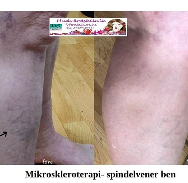 Ben med två ådernätskluster före skleroterapi och 6 veckor efter behandling.