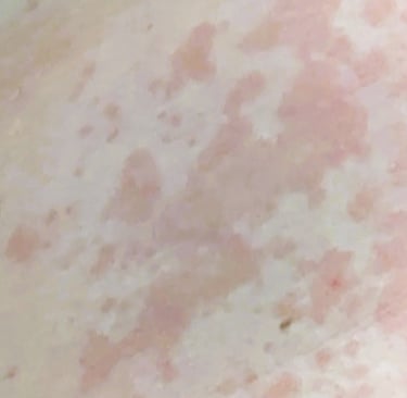 tinea versicolor on caucasian skin