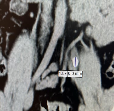 Böbrek taşının tomografi görüntüsü