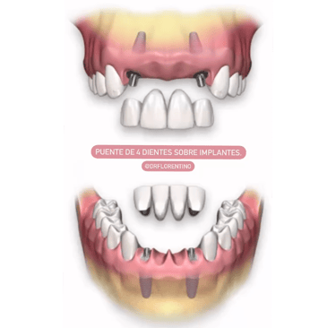 Puente de 4 dientes sobre implantes dentales
