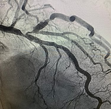 a heart with a vein vein on the left side of the heart