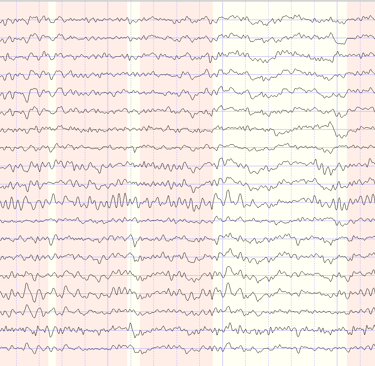 Fond d'une image montrant un tracé EEG